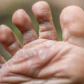 Say Goodbye to Foot Fungus: What Is Athlete's Foot Fungus Between the Toes and How to Get Rid of It Fast