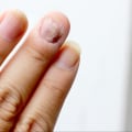 Nail Mold vs Fungus: Shocking Differences You Must Know