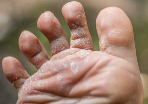 Say Goodbye to Foot Fungus: What Is Athlete's Foot Fungus Between the Toes and How to Get Rid of It Fast