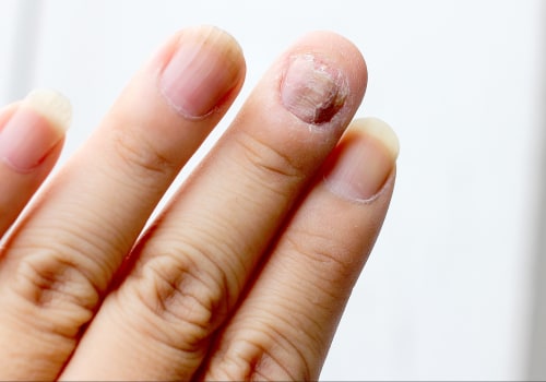 Nail Mold vs Fungus: Shocking Differences You Must Know